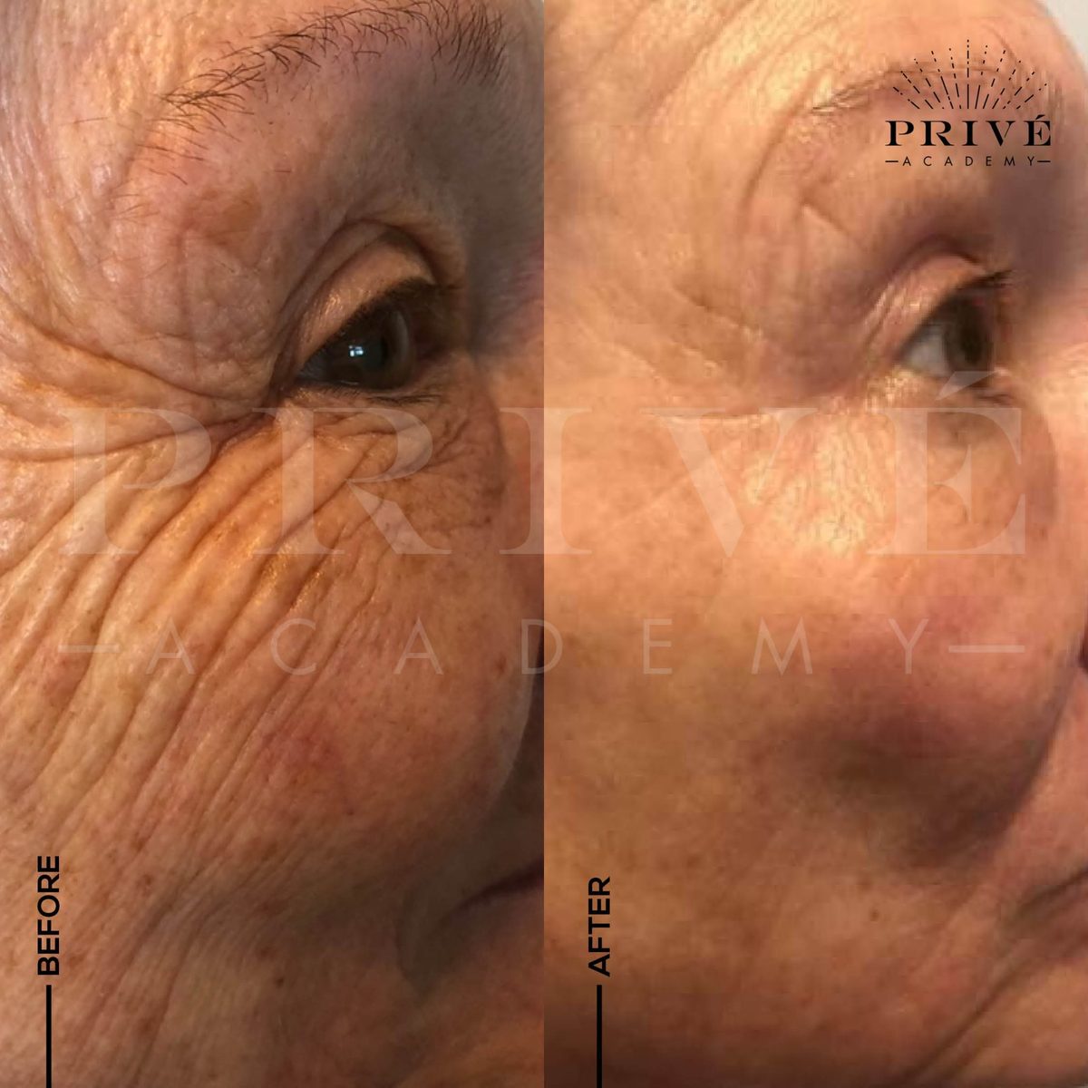 Deep crow's feet before and after Plasma Fibroblast