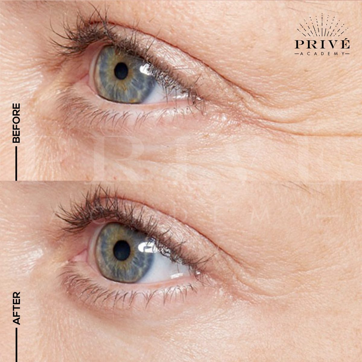 Close-up of crow's feet before and after Plasma Fibroblast, with visibly softer lines