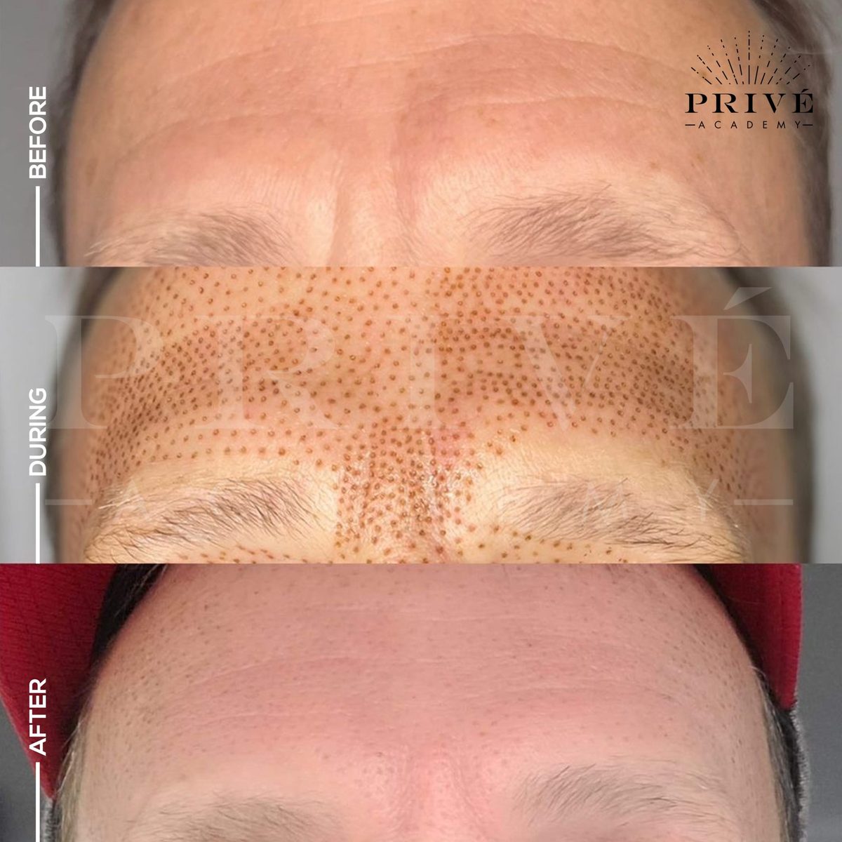 Forehead before treatment, during healing with carbon crusts, and after, with smoother forehead lines