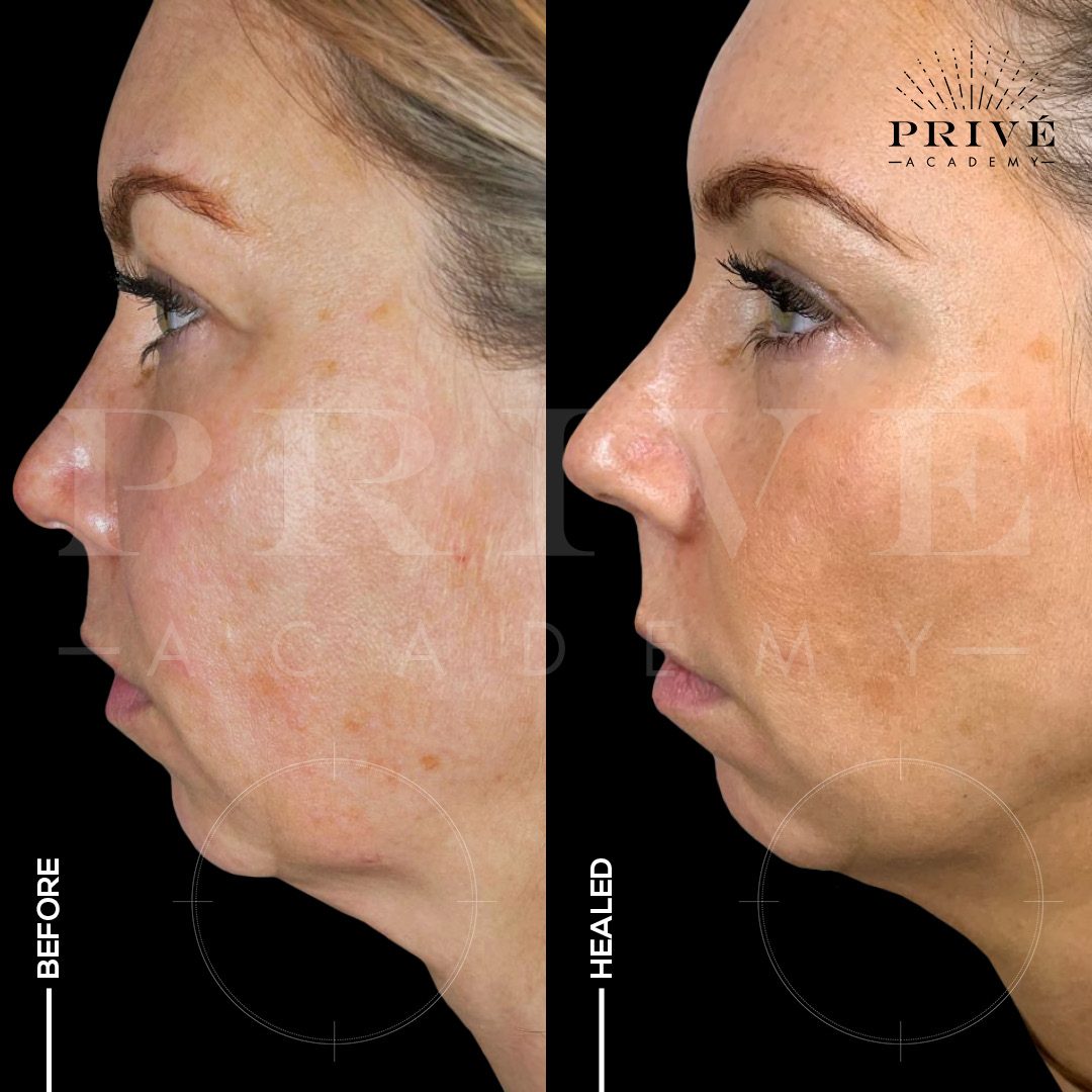 Jawline before treatment and healed, side profile