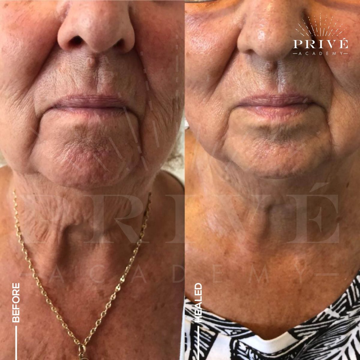 Lower face and neck before and after healing from Plasma Fibroblast