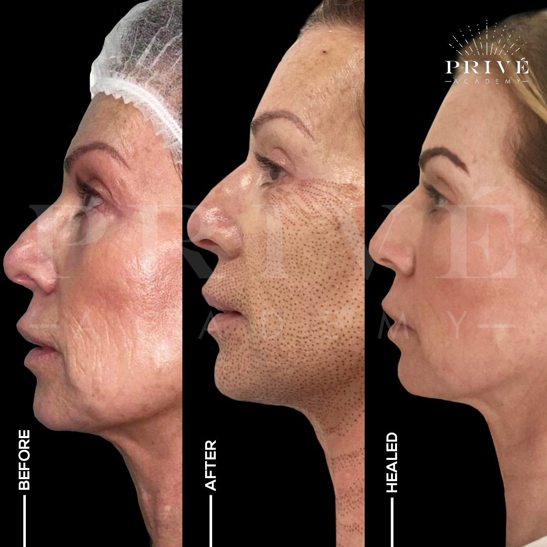 Profile view of a client before Plasma Fibroblast, immediately after, and healed, showing a tighter jawline and smoother cheek