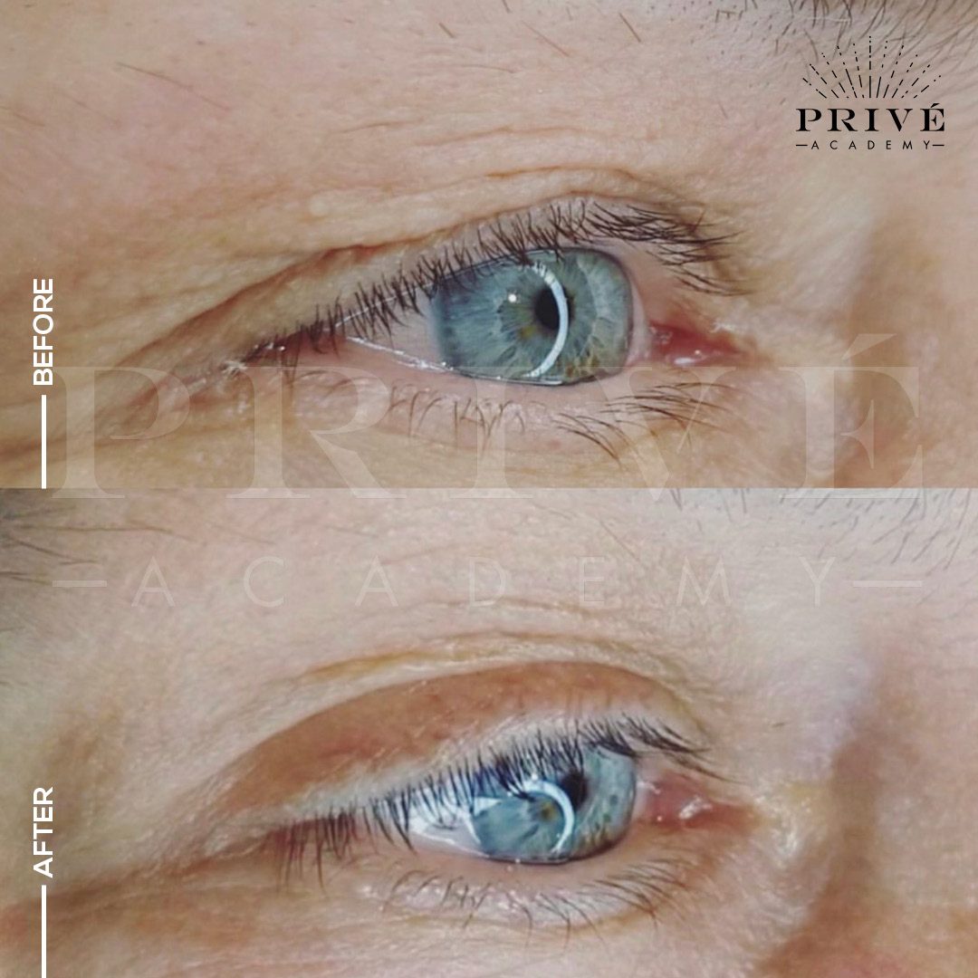 Upper eyelid before and after treatment