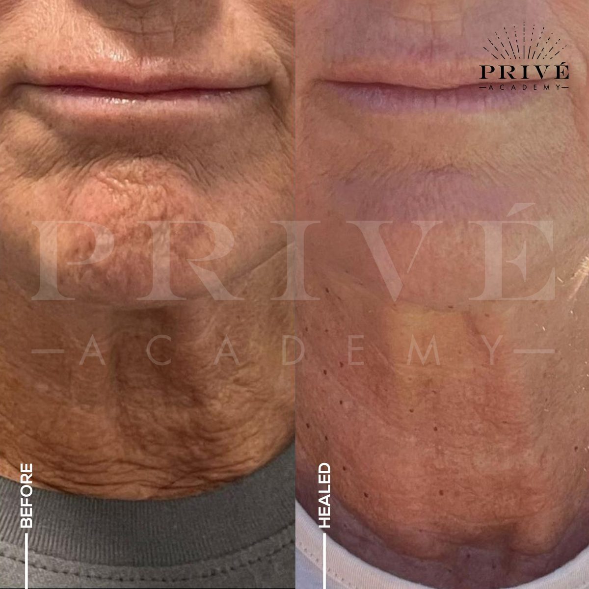 Lines above the upper lip before and after healing from Plasma Fibroblast