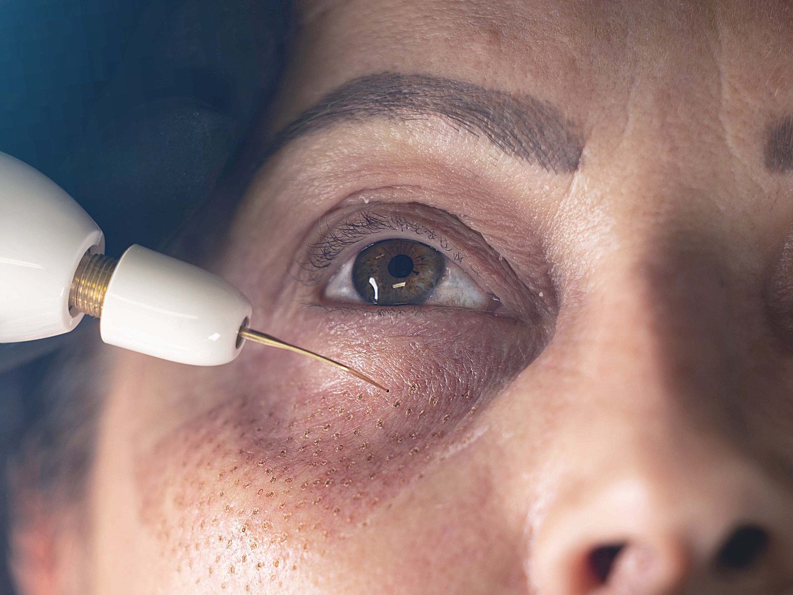 Close-up of a plasma pen tip working under a client's eye, with fresh treatment dots on the skin