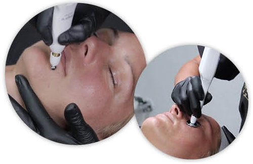 Two close-ups of a professional device with a soft-lifting attachment during treatment
