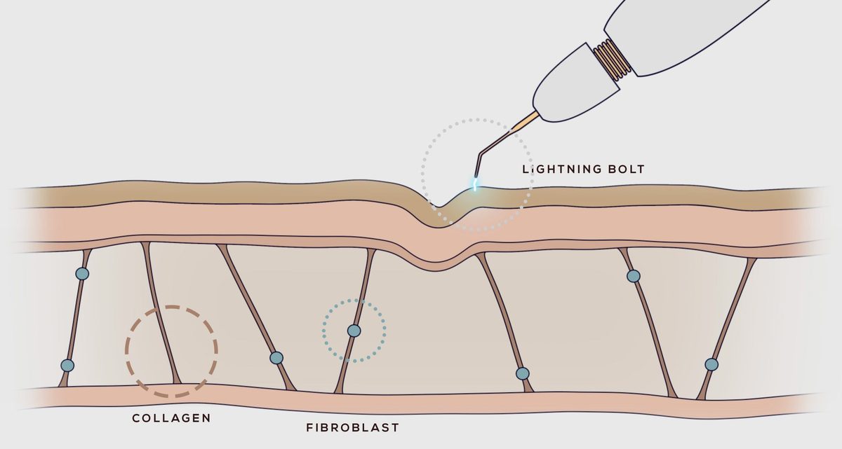 Illustration: a precise plasma dot touches the upper layer of the skin, above the collagen fibres and fibroblast cells beneath it