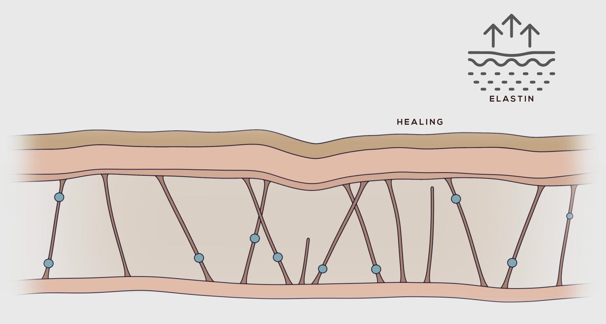Illustration: the treated dot healing, with new collagen and elastin fibres starting to form underneath