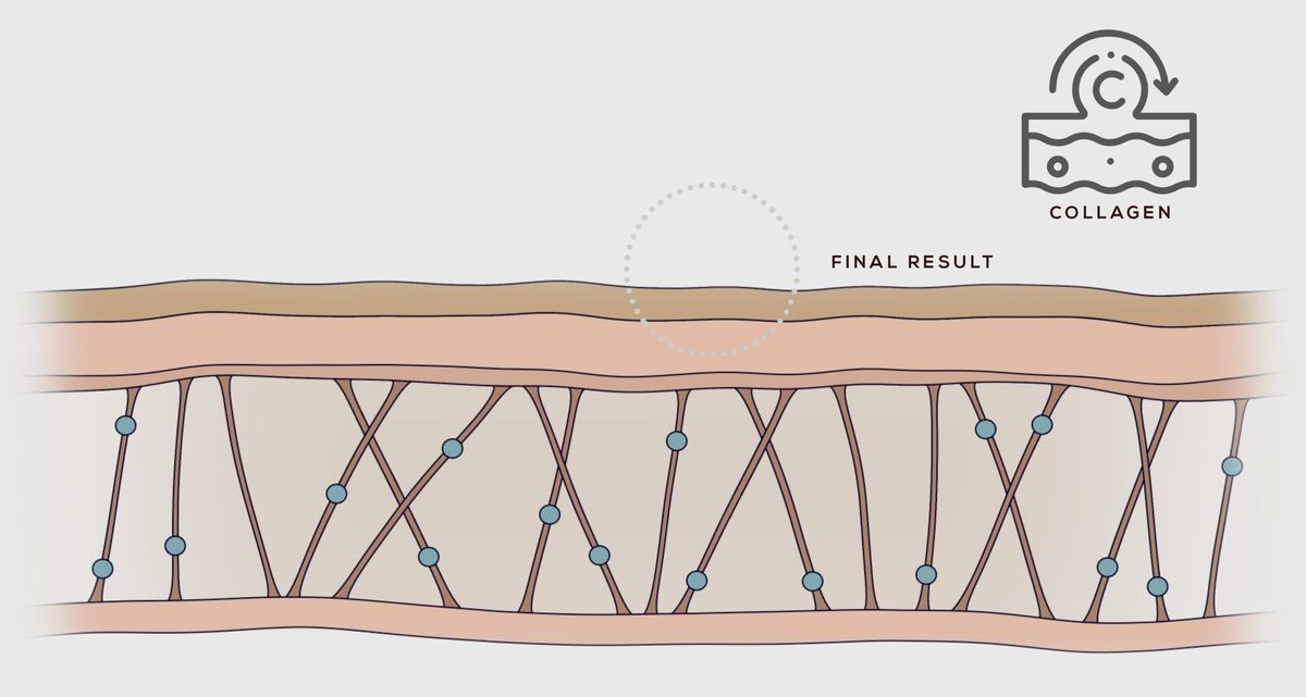 Illustration: the healed skin, a smoother surface over a denser network of collagen fibres
